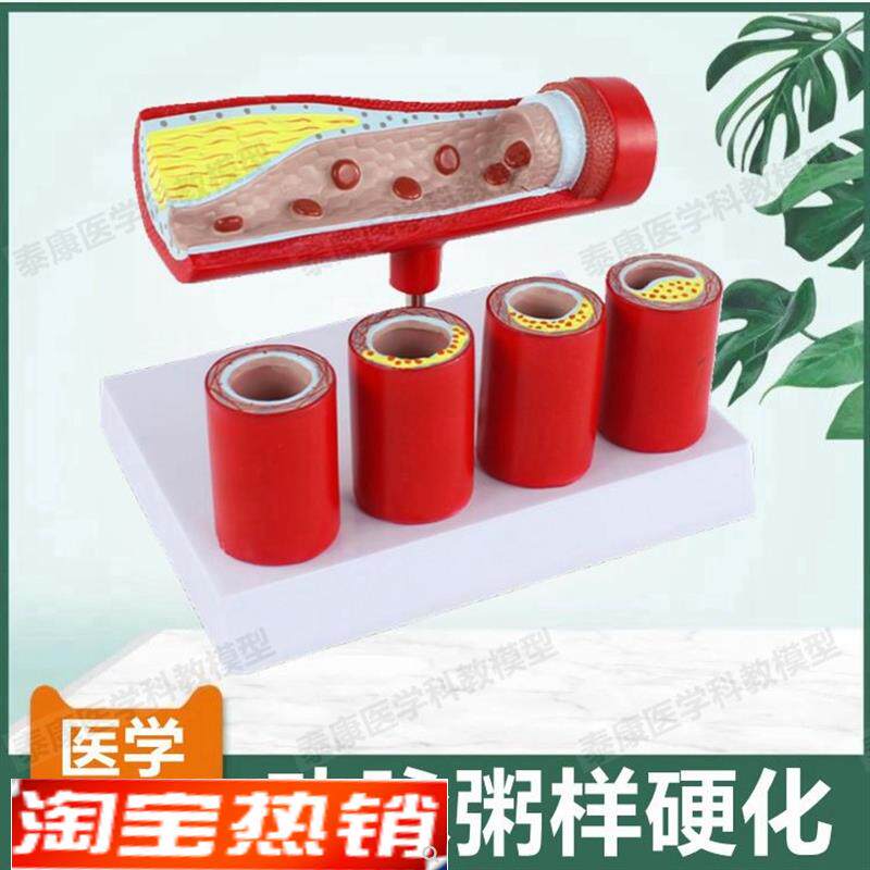 动脉血管模型内膜粥样斑块阻塞狭窄硬化医患O药礼品血管壁层次解