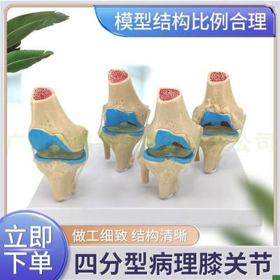病态膝关节模型四阶段病理膝关节模型病R变人体膝关节模型