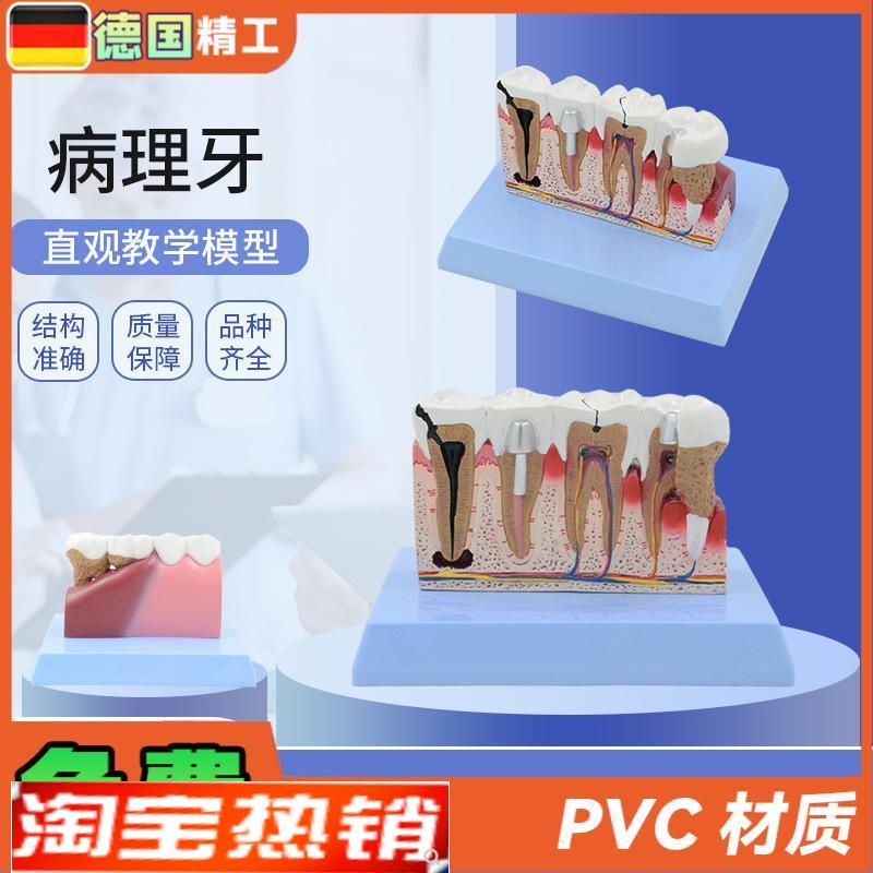 德国牙齿牙科病理学医学教学沟通A模型解剖放大病理演示牙科模型
