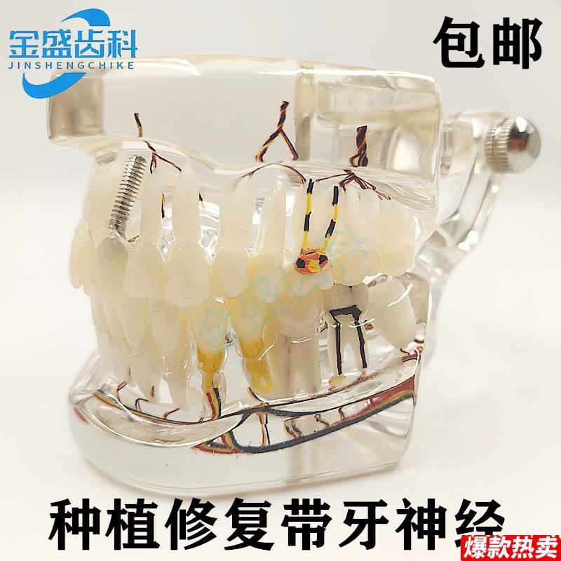 牙科口腔教学模型种植修复D体牙模型种植带牙神经模型医患沟通展