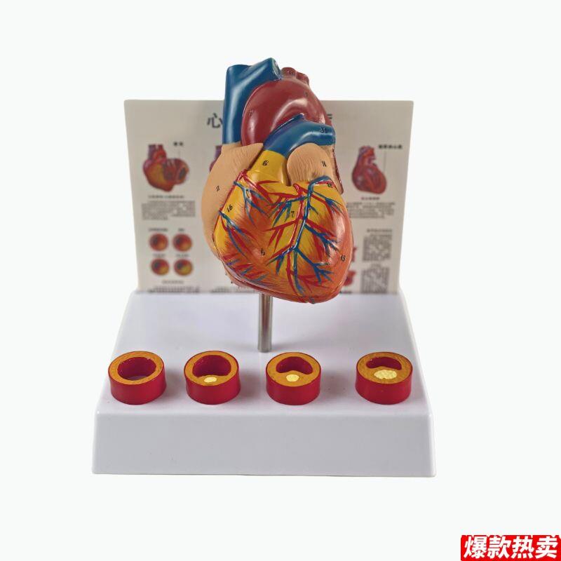 康泰模型心血管粥样硬化狭窄阻塞病理冠状动脉临e床医药促销人体