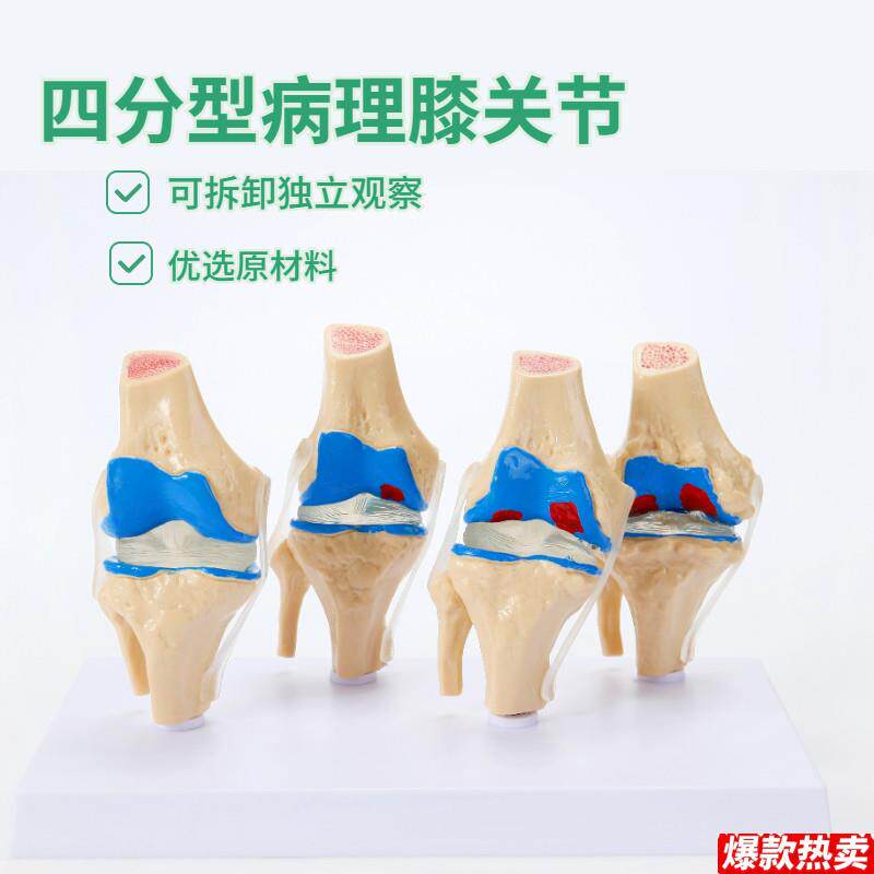 人体病理d膝关节模型病变四分型膝关节退行性膝关节关节镜手术沟