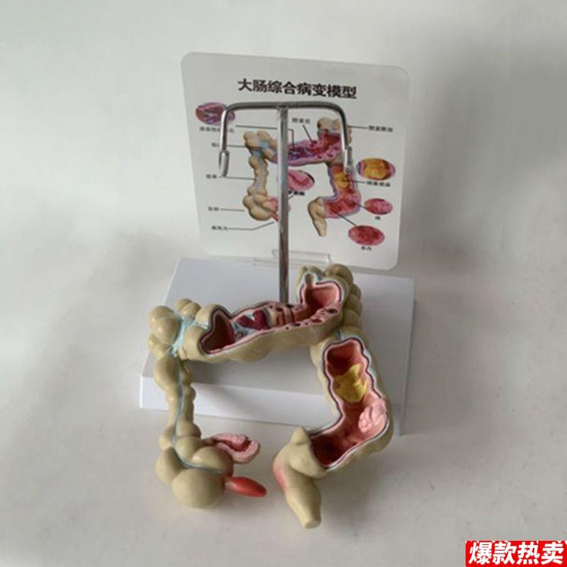 康泰教具炎阑尾盲Q肠大肠扭转阻塞梗阻人体消化道医药促销结肠病