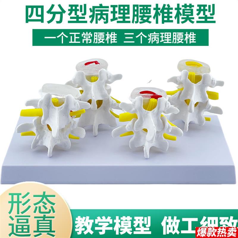 四分型脊椎正常与病变腰椎组合模型椎间盘k病理腰椎演示过程病变
