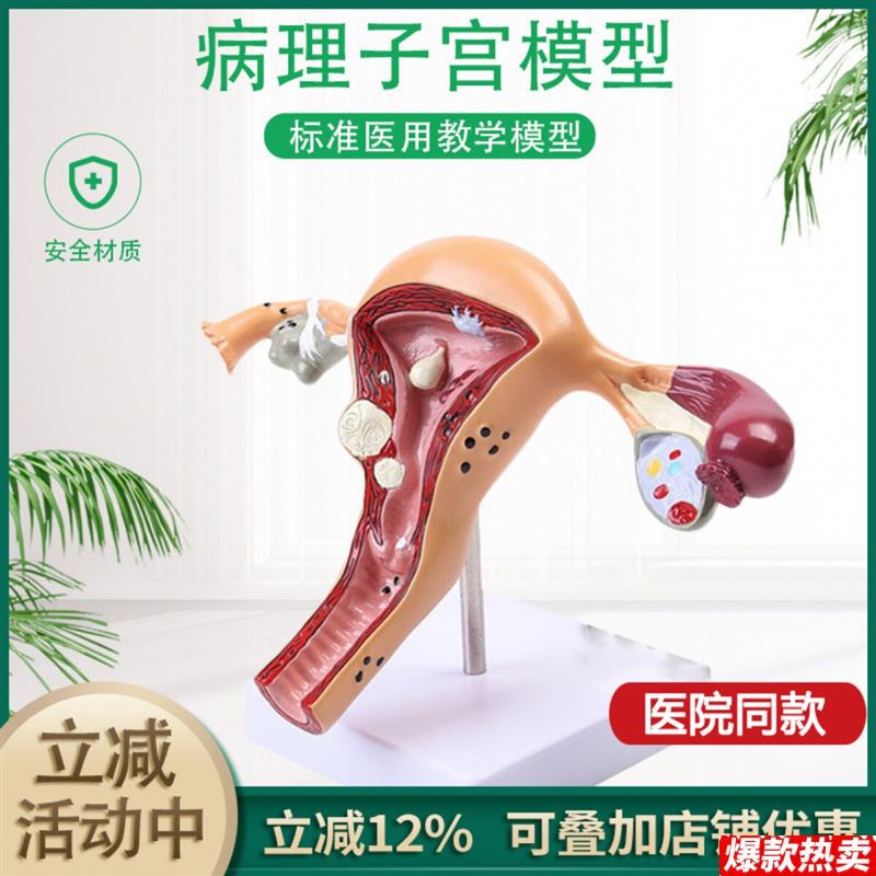人体模型女.性生殖子宫阴道卵巢子宫教学模具病理变化科普培训教