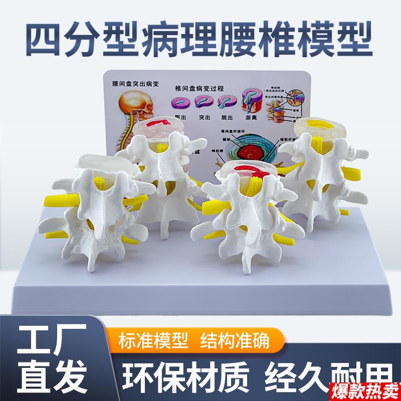 教学彷真病理脊椎模型四分型脊椎正常与病变u腰椎组合模型人体脊