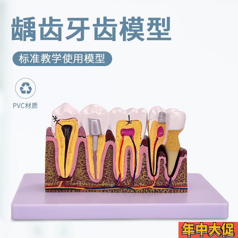 牙科口腔6倍综合病理模型 人体龋齿解剖根管O及牙神经展示教学模