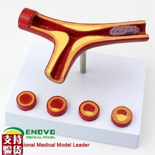 颐诺正品冠状动脉性心血t管动脉硬化模型老年心脏模型血栓形成