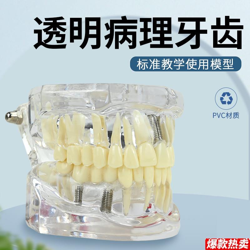 牙科修复模型口腔科病V理医患沟通教学修复体综合带神经可拆卸牙