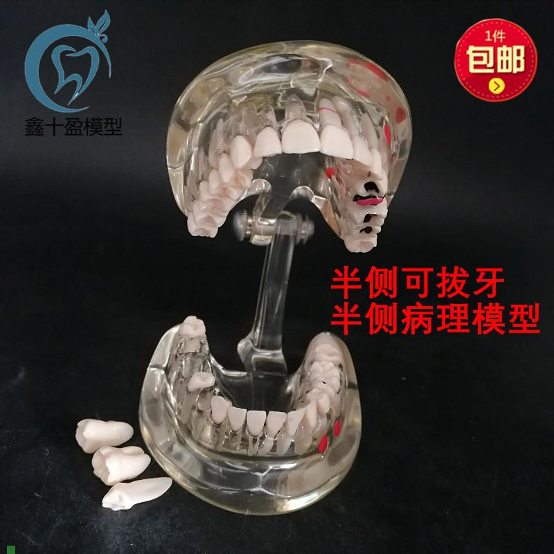 牙科牙齿模型成人病理半侧可拔牙模型医患沟通口腔W教学教具C3