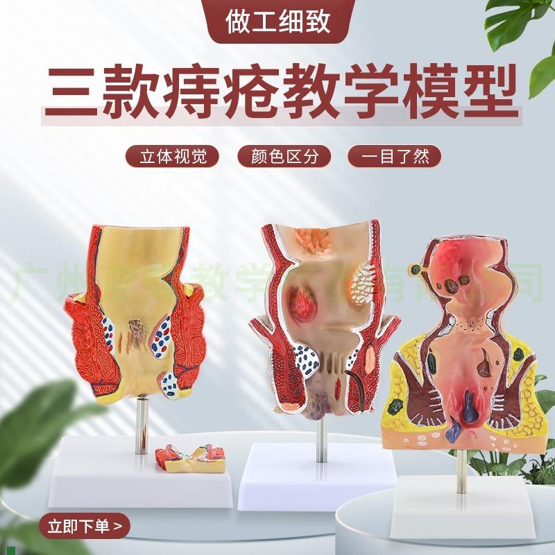 痔疮直肠病理模型溃杨性结w肠病肠直肠解剖病理模型病态疾病教具