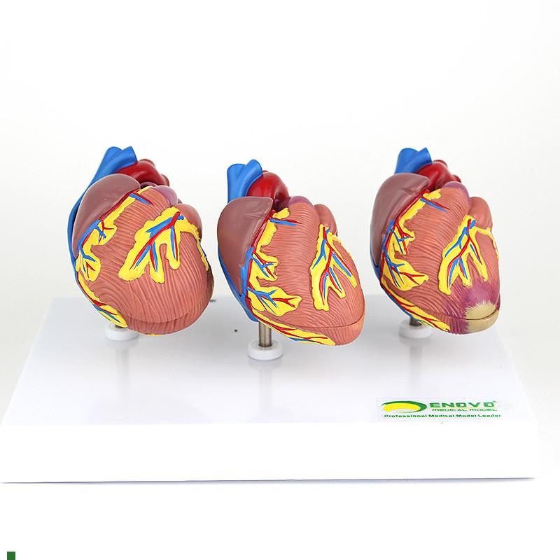 ENOVO颐诺i心脏病演示模型心血管系统心肌梗死充血性心力衰竭心