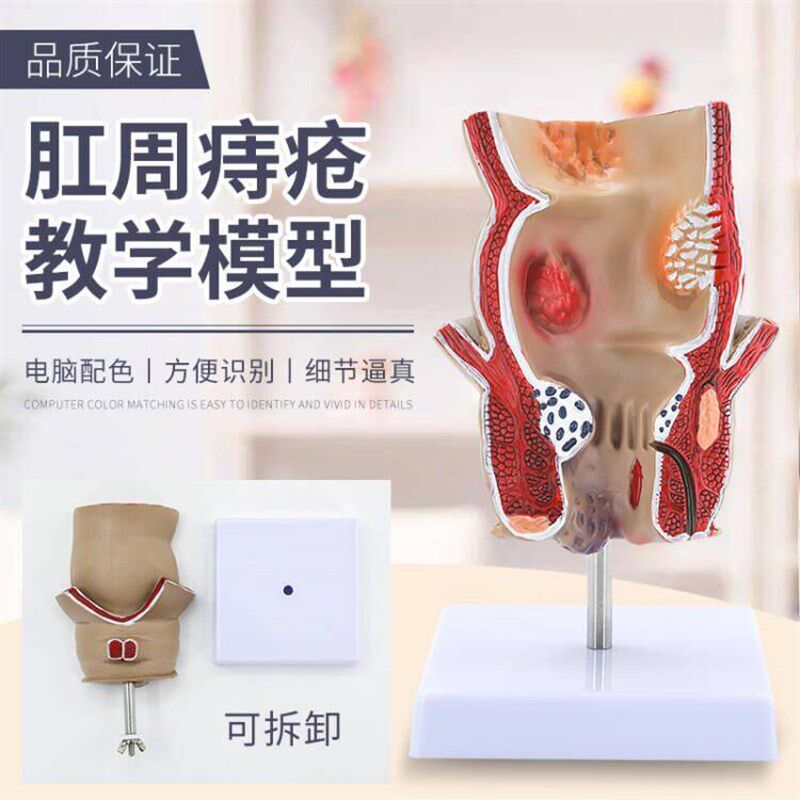 教学彷真人体直肠和肛门u肛肠疾病痔肛娄溃疡性结肠病理痔疮模型