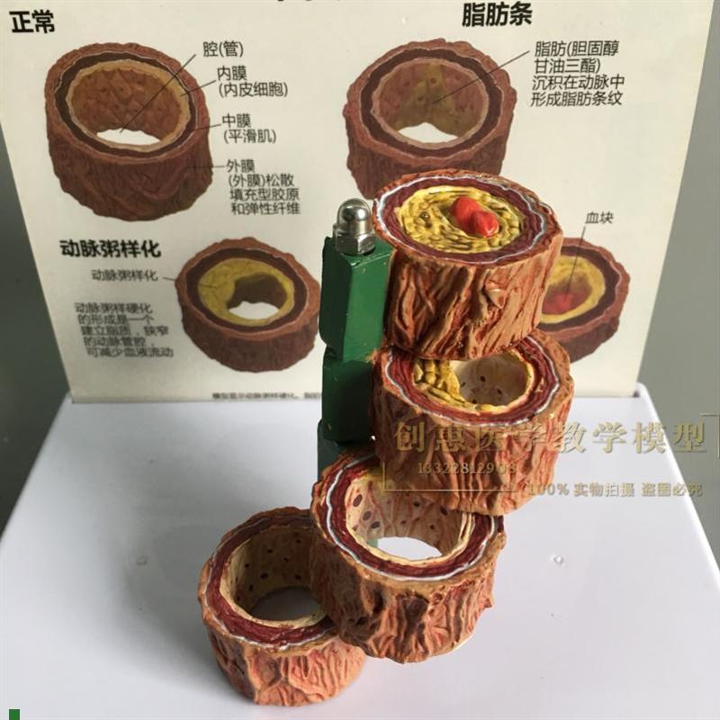 血管解剖模型动脉粥样化病理心血管血O液循环医学促销模型