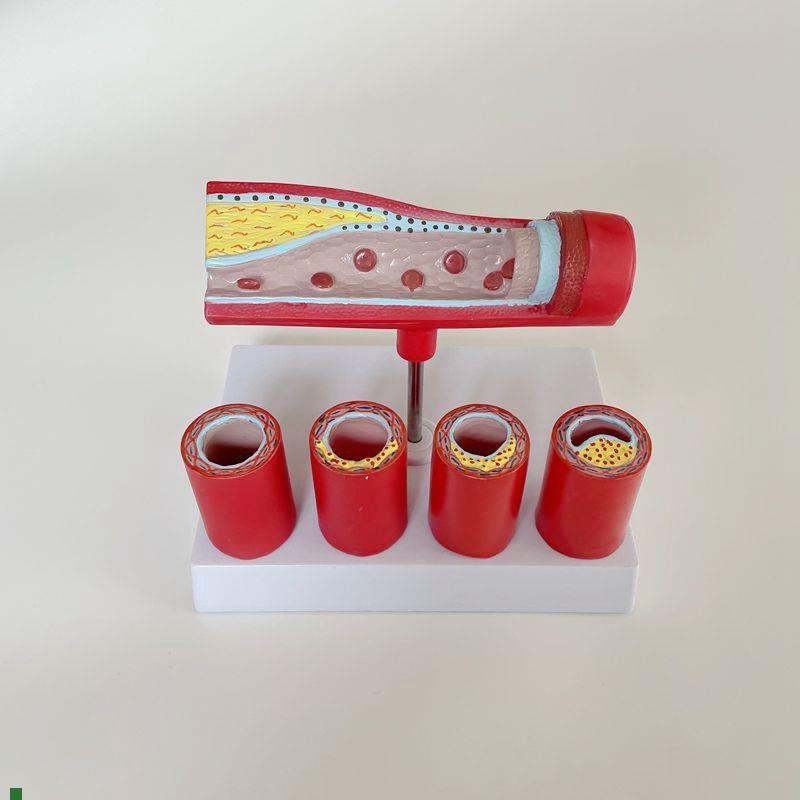 动脉血管阻塞模型粥样变化栓塞狭窄中老年人血R管心脏冠状动脉脂
