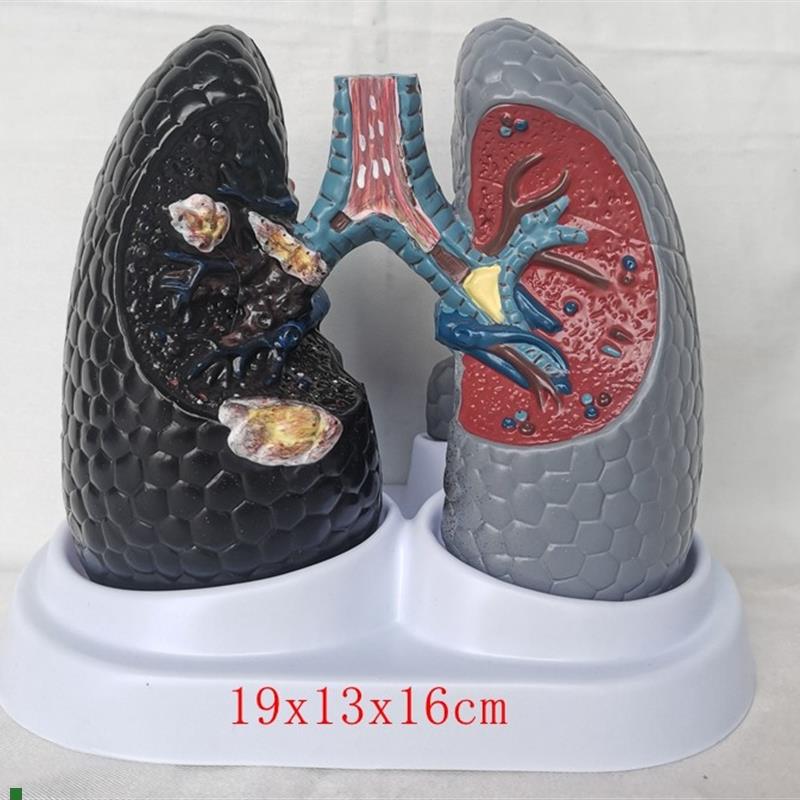 人体吸烟癌变肺模型健康肺w模型人类内脏吸烟肺与健康肺模型