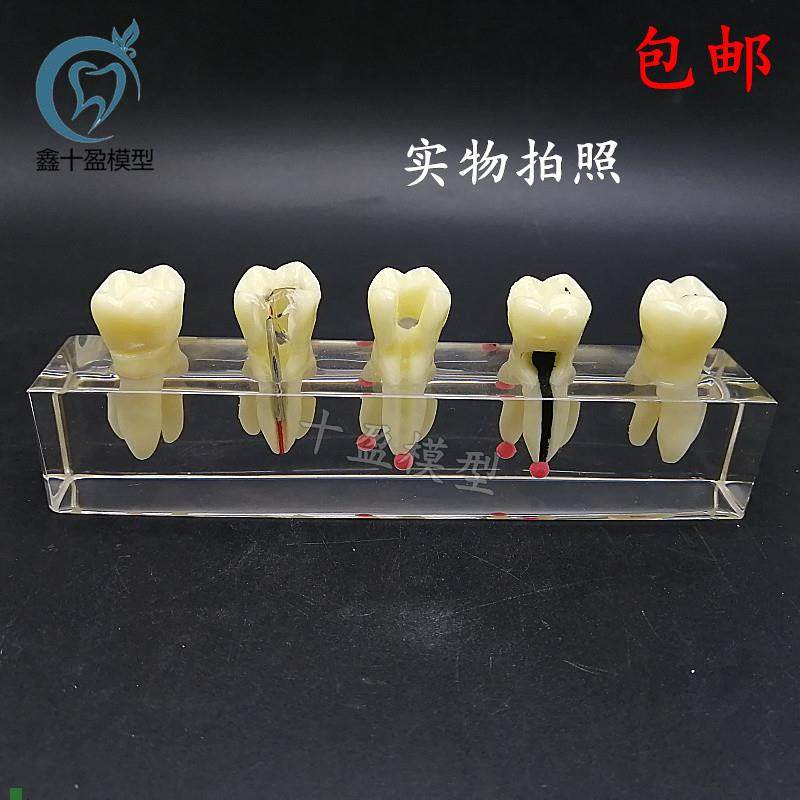 口腔教学模具水晶根l管治疗模型可拆修复牙冠龋齿蛀牙病理M4012