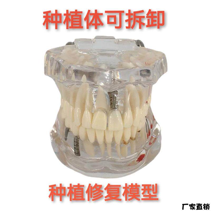 牙科材料修复牙模型水晶病理牙A模型活动种植牙模型包邮