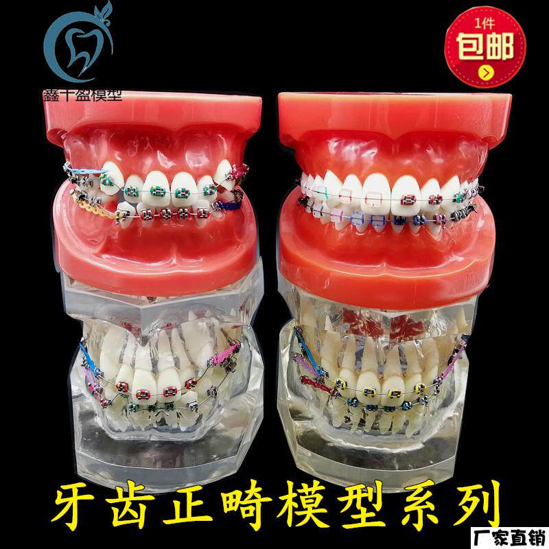 牙科正畸模型透明错颌矫正展示模型结扎丝托槽正v畸带支抗钉牙列