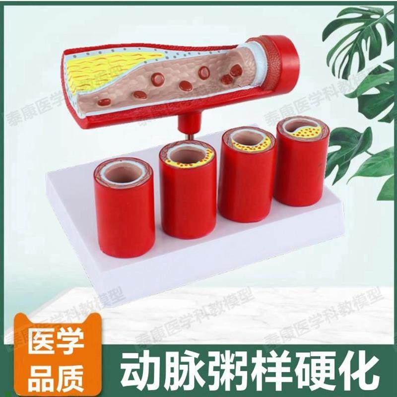 动脉血管模型内膜粥样斑块阻塞狭窄硬化医患药P礼品血管壁层次解