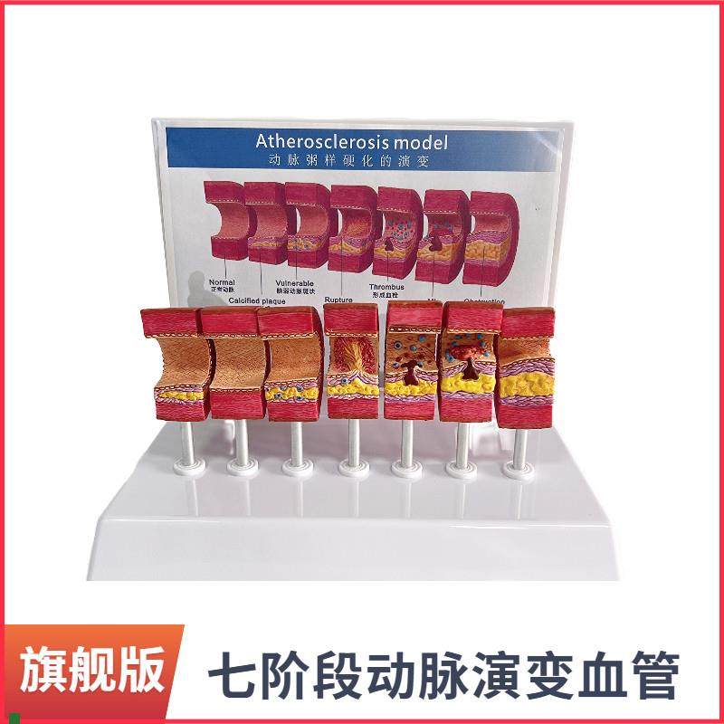 动脉粥样硬化模型血管血栓栓w塞模型动脉血管人体医用医学教学教