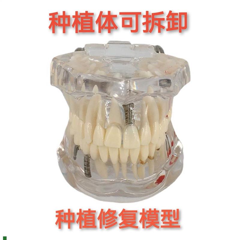 牙科材料修复牙模型水晶x病理牙模型活动种植牙模型包邮