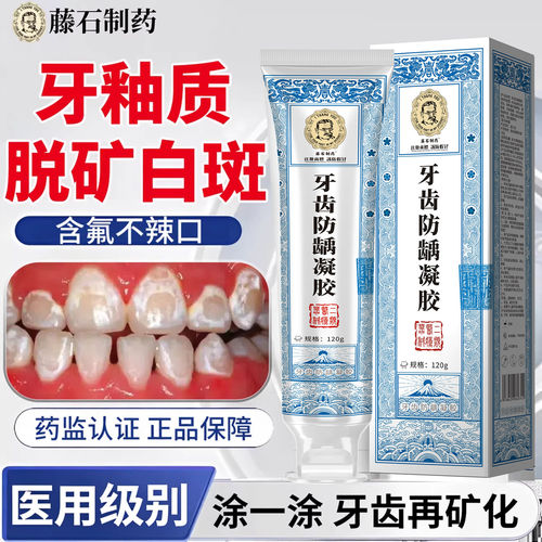 牙齿脱矿白斑钙化修复牙
