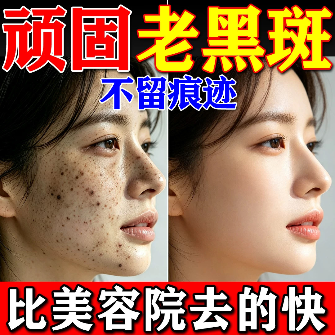祛斑精华液祛黄褐斑雀斑分解黑色乳液/面霜