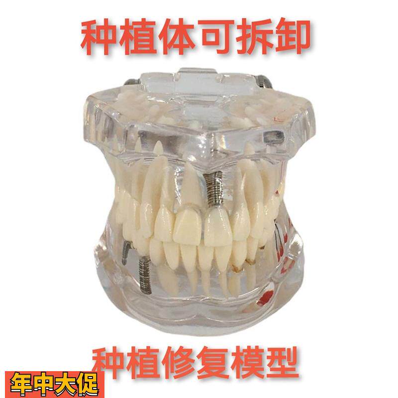 牙科材料修复牙模型水晶病理牙模型活动种植牙模型包邮