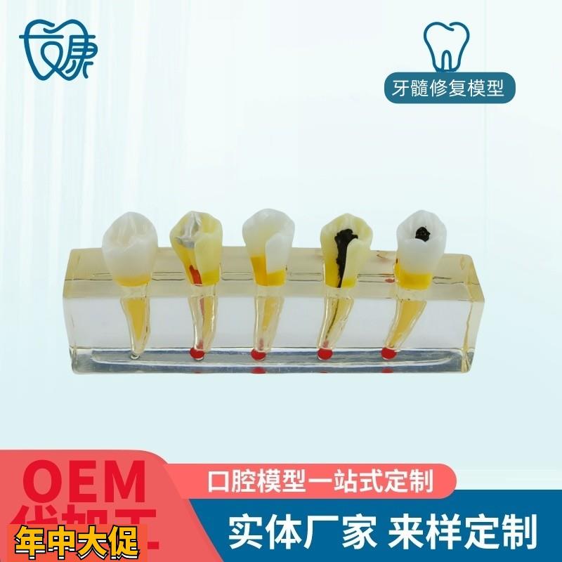 牙科医患沟通病理模型牙髓病修复模型展示牙髓牙髓治疗模型