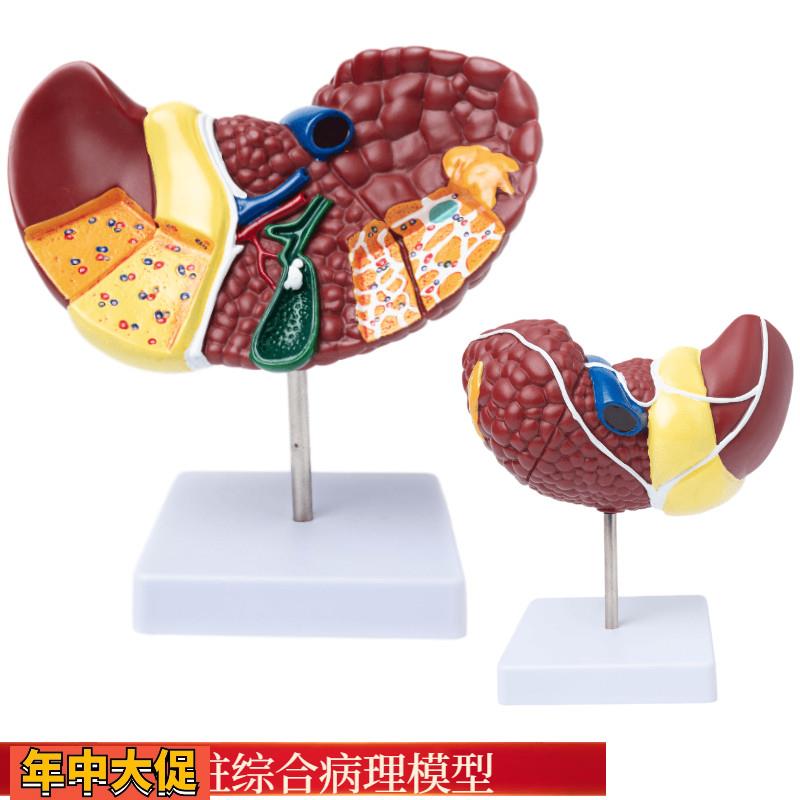 彩色肝脏模型常见临床病理特征医生用医患沟通硬化脂肪炎肝胆内科