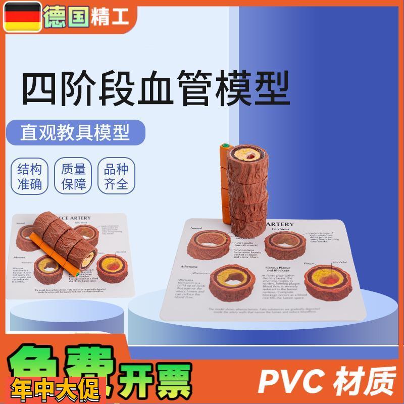 德国】血管模型人体四阶段血管标本心内科医患沟通演示血管硬化模