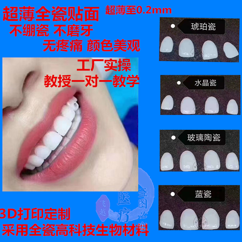 全瓷贴面超薄瓷贴面明星冰瓷牙矫正牙釉质牙齿美白瓷贴片铸瓷琥珀