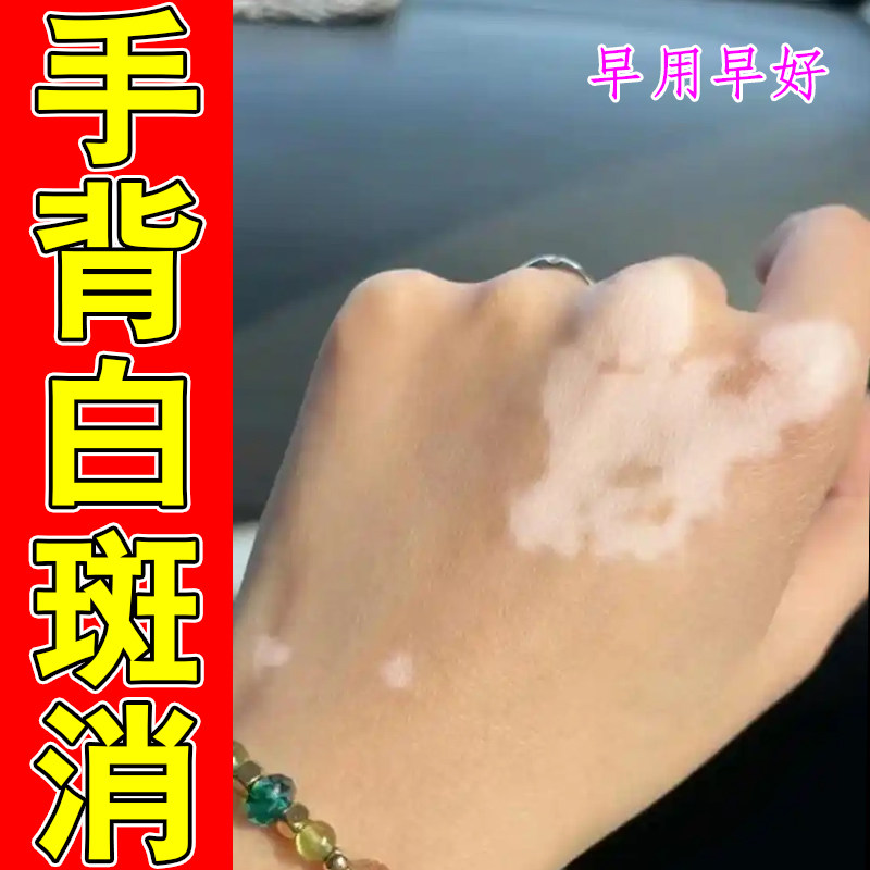 冶胳膊肤色变浅白印四肢零星白点手背色素不均斑块小腿淡白斑腰腹