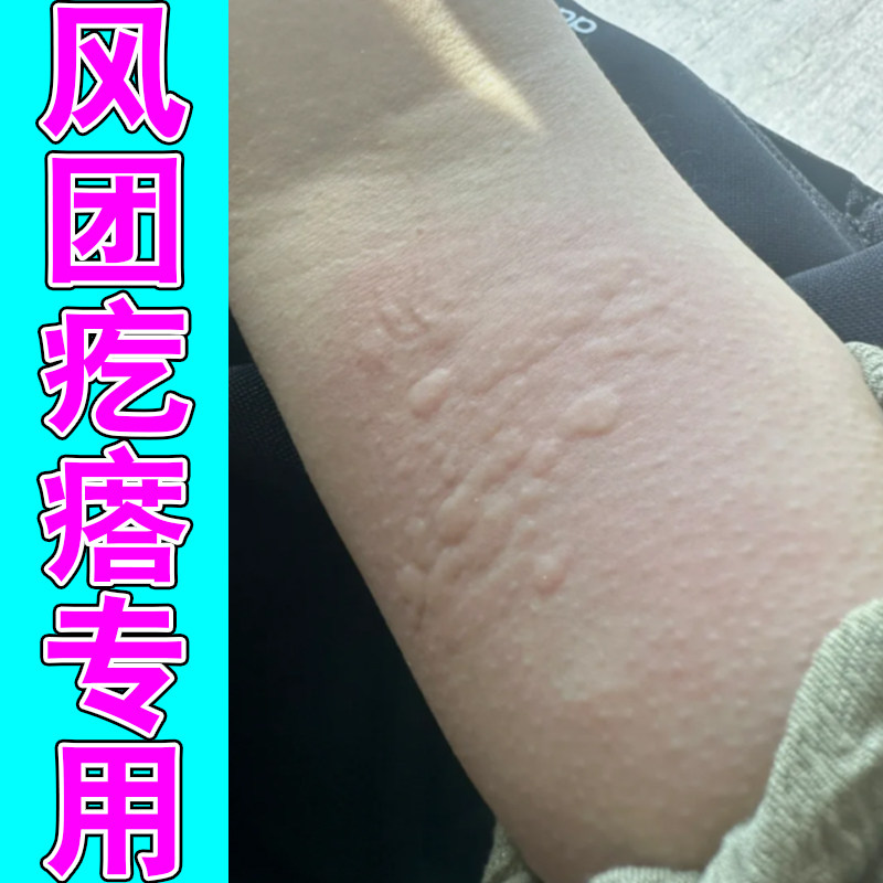 风团疙瘩专用换季过敏身上长红点老年人皮肤痒掉屑红肿寒冷性外用