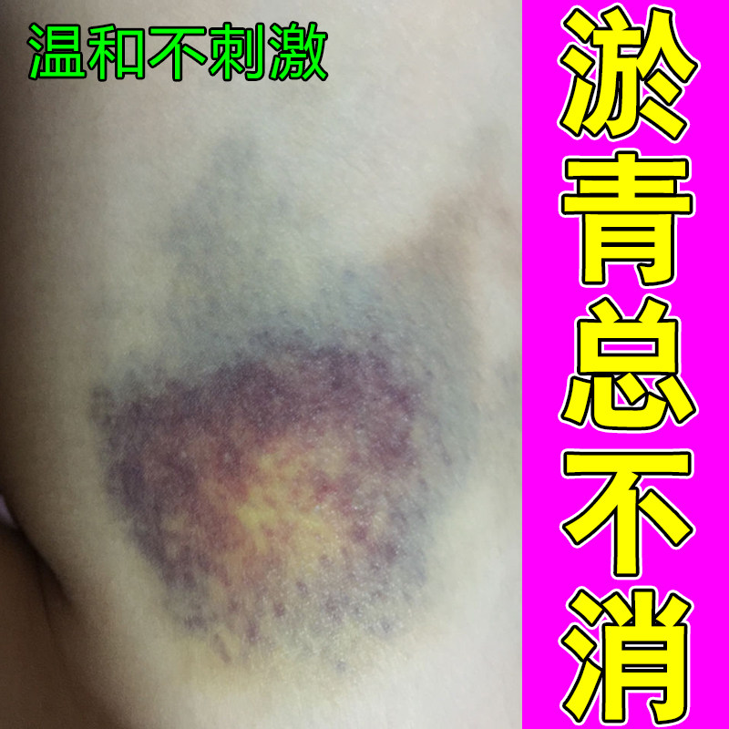 小腿内侧大腿碰撞乌青印皮下浮现紫暗色斑块腿部无故出现青印外力