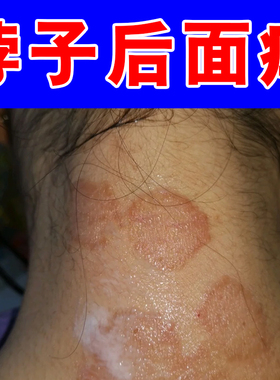 脖子刺挠红痒起疙瘩红肿长红点神经性换季过敏脖圈红斑痒秋冬换季