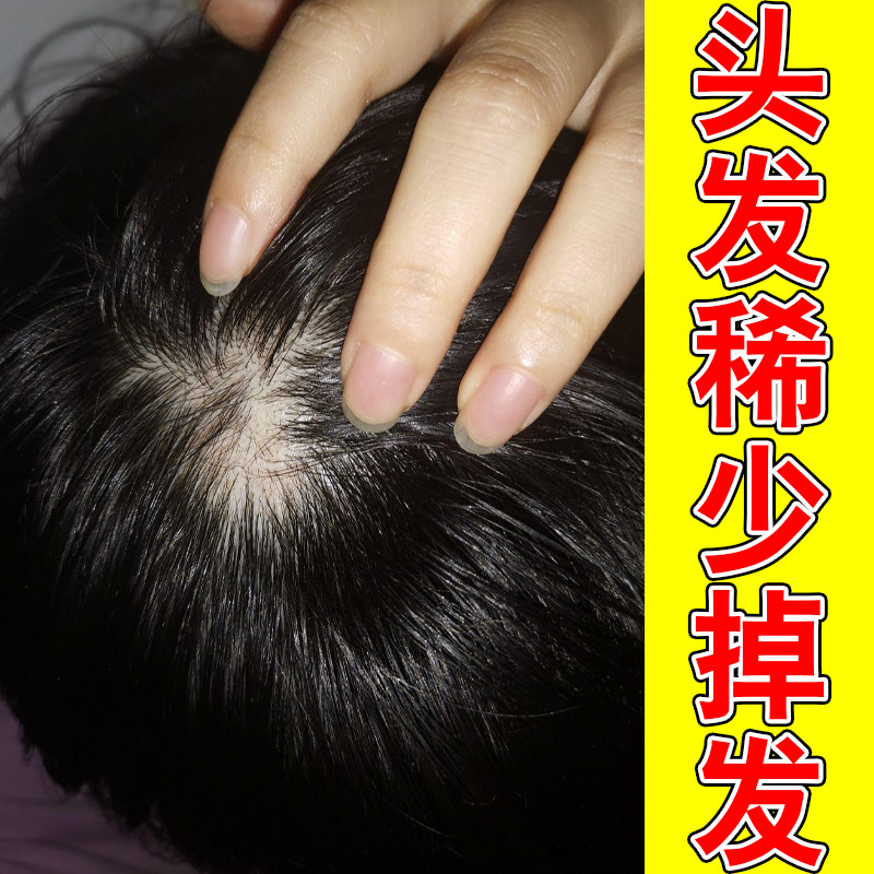 头部斑秃片状掉发头皮滋养修护液温和调理头皮环境改善秃斑发根药