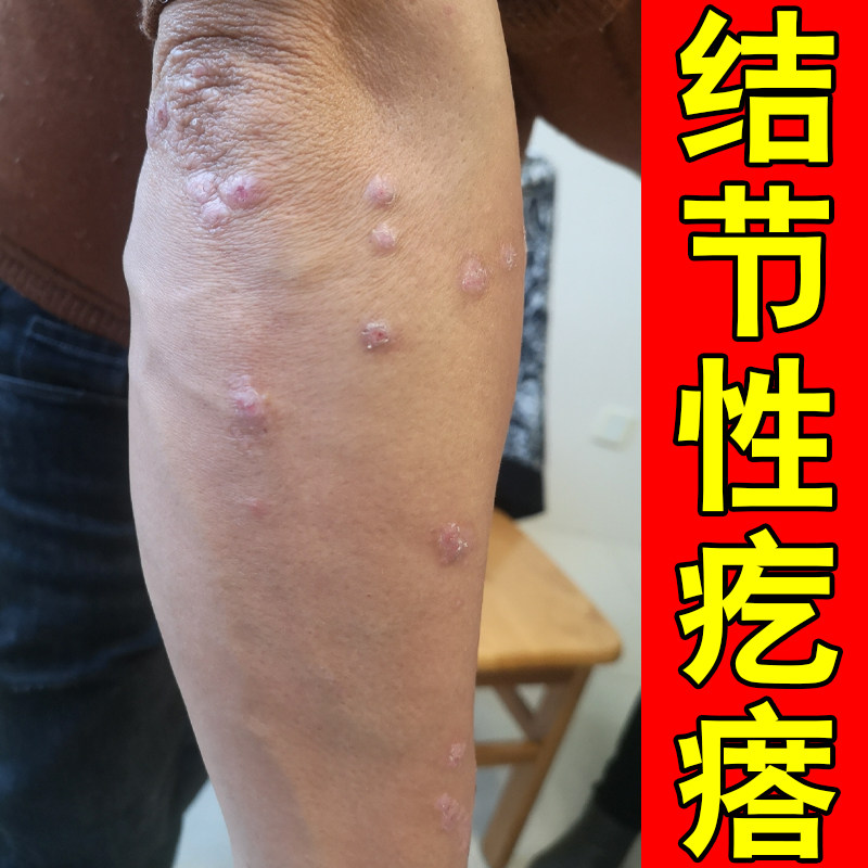结节性疙瘩四肢起硬块脓包痘皮肤干燥粗糙掉屑红肿身上长硬疙瘩痒
