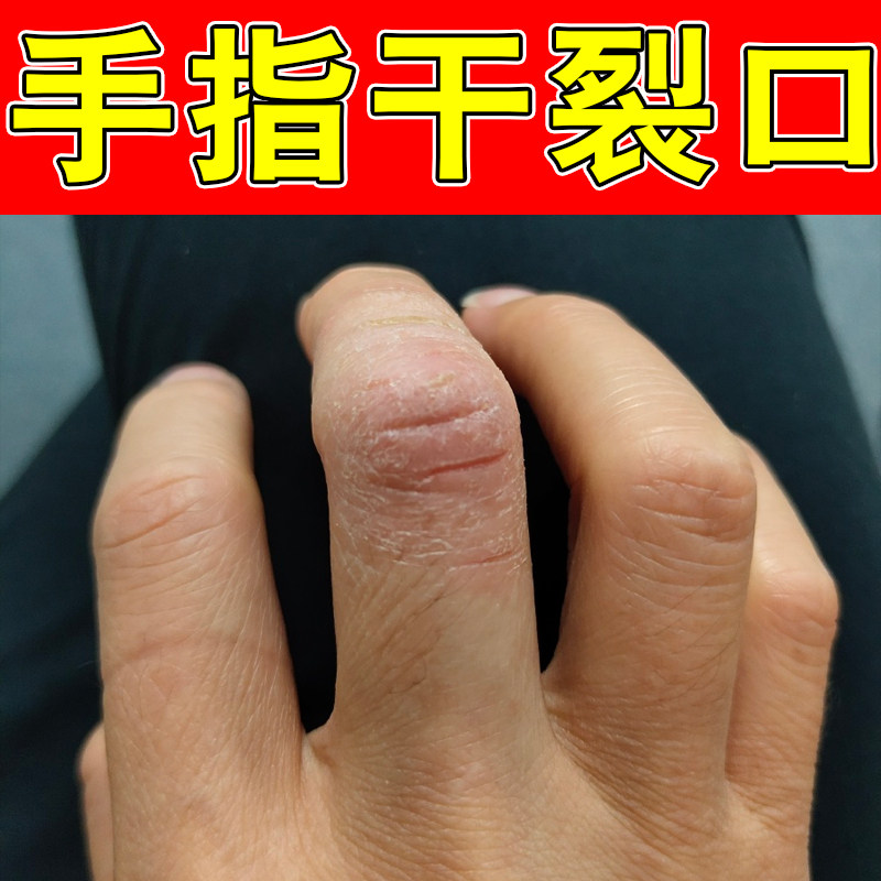 手指干裂口手部皮肤干燥蜕皮裂口子角化型去角质手部泛红刺挠保湿