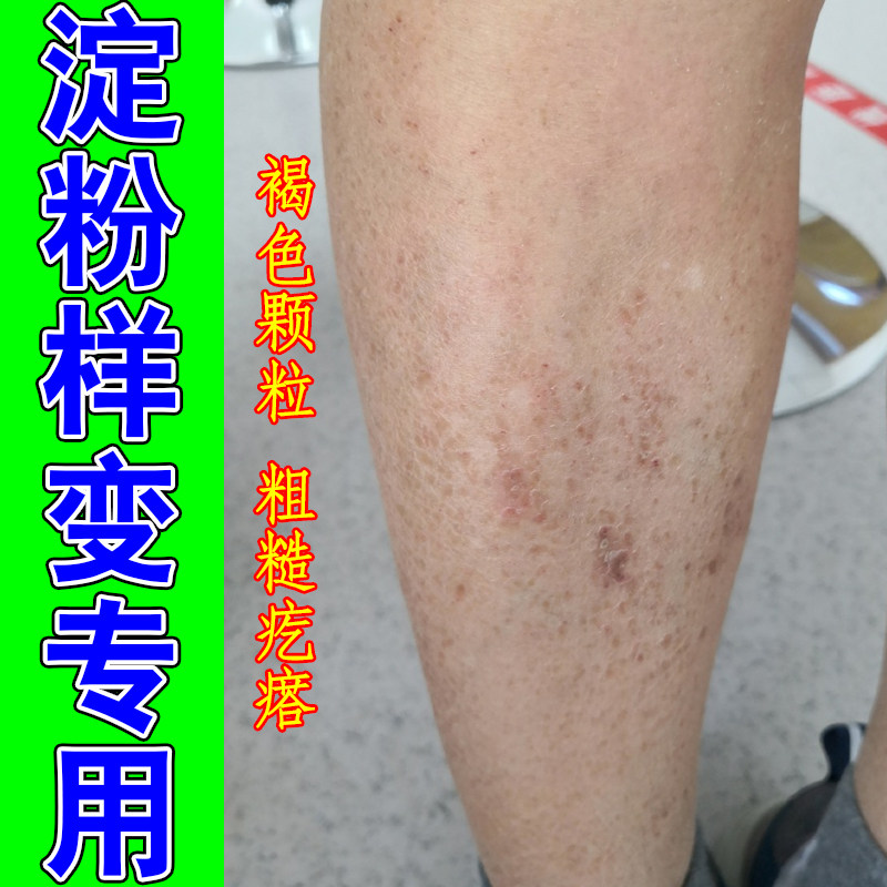 小腿剧烈痒褐色蛋白沉积胳膊粗糙干燥痒黑色素沉淀凸起颗粒修护药