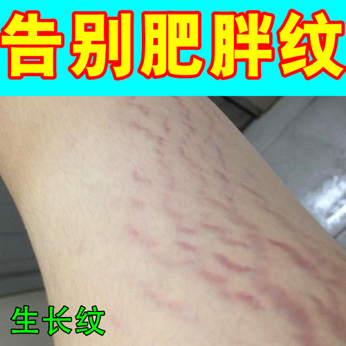 大腿学生生长纹肥胖纹修复药乳霜