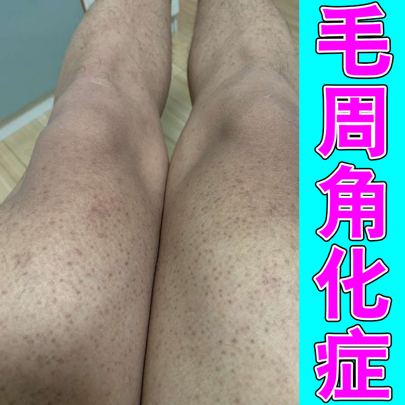 毛周角化症胳膊上长小疙瘩痘皮肤皮肤消毒护理（消）