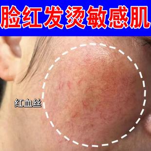 脸红发烫敏感肌去红血丝角质层增厚皮肤屏障受损改善修复保湿药乳