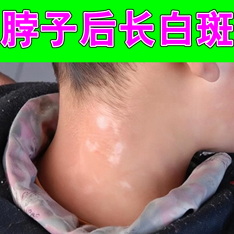 脖颈面部淡白斑脱失黑色素身上浅色斑块白点肌肤日常外用温和药乳