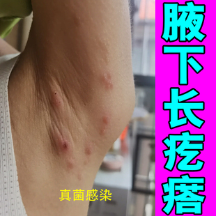 腋下长疙瘩防摩擦冶胳肢窝出汗异味起痘痘红肿痒汗斑红斑专用修复