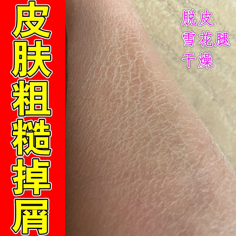 皮肤干燥起皮身体油马来西亚护肤甘油鱼鳞皮润肤乳液全身干燥皮肤