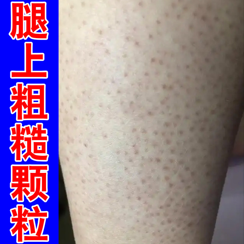 腿上粗糙颗粒毛周角化症毛囊堵塞皮肤消毒护理（消）