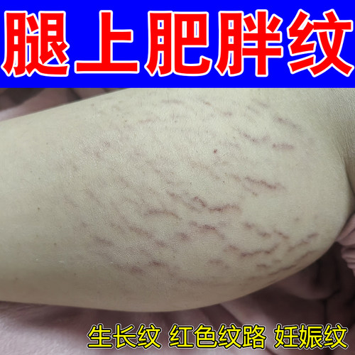 腿上肥胖纹专用妊娠纹青少年生长纹身上白色纹路红色纹路修护保湿