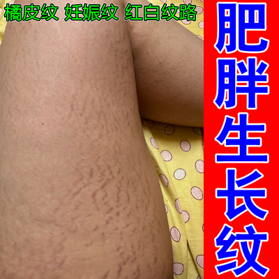 妊辰纹消除去肚子妊娠纹修复霜淡化黑色素肥胖疤痕除疤专用淡纹膏